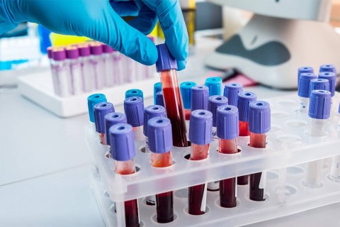 Analize medicale - DEPISTARE DIABET - MONITORIZARE DIABET