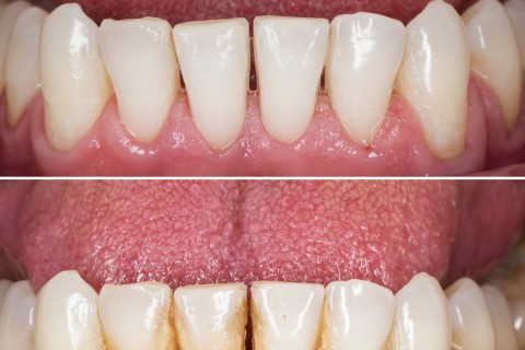 Igienizare dentară
