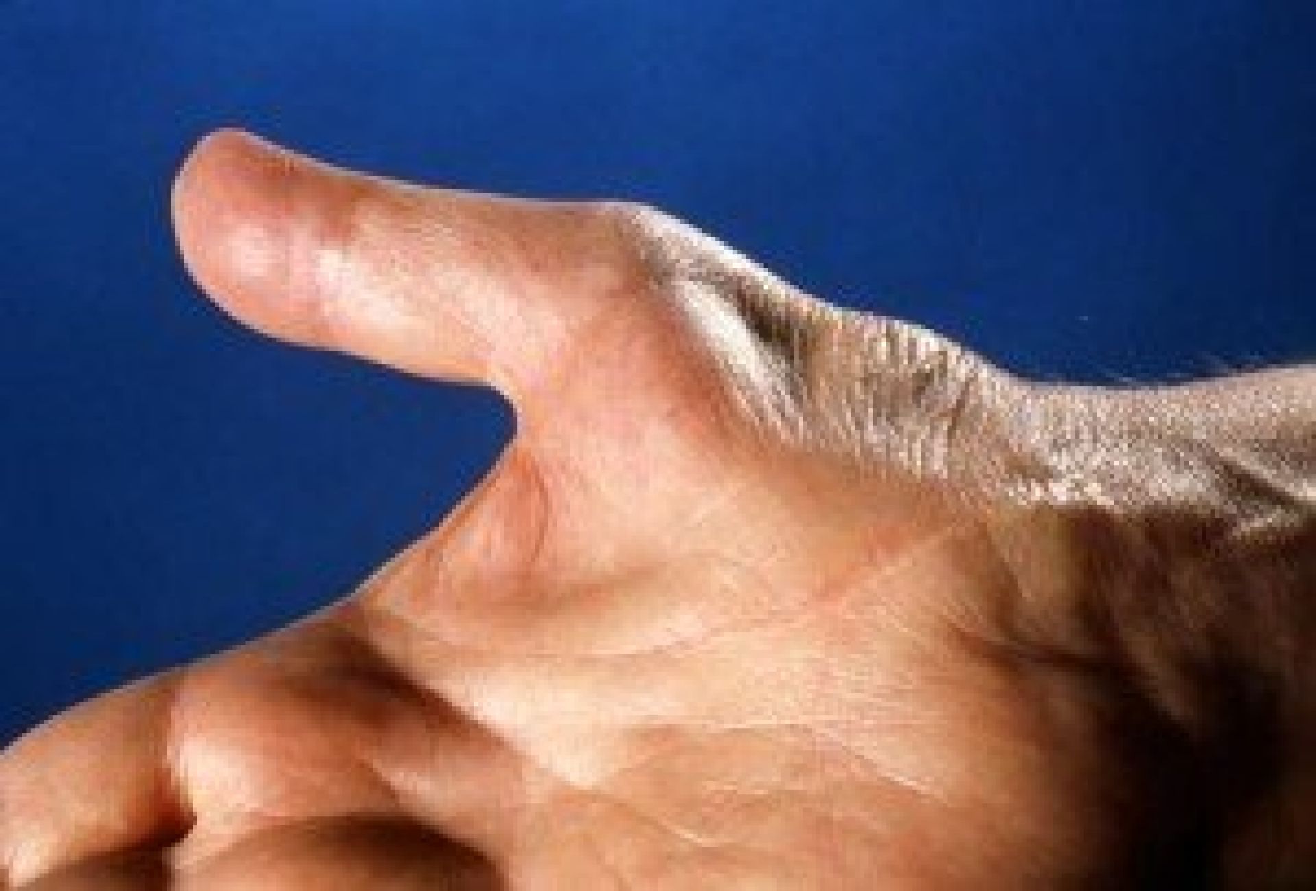 Заболевание мышц рук. Атрофия большого пальца руки.