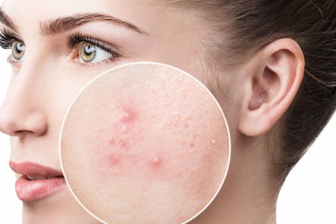 Pachet dermatologie (diagnostic si tratament acnee)