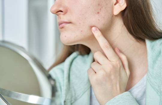 7 metode pe care le poți aplica acasă ca să scapi de acnee